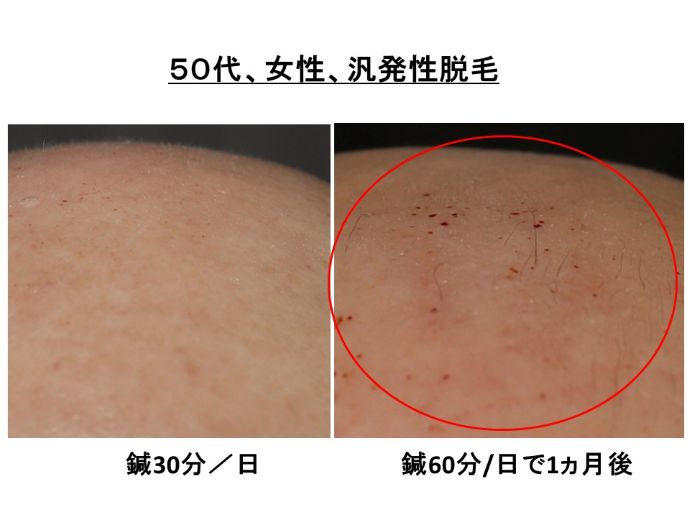 円形脱毛症　病院